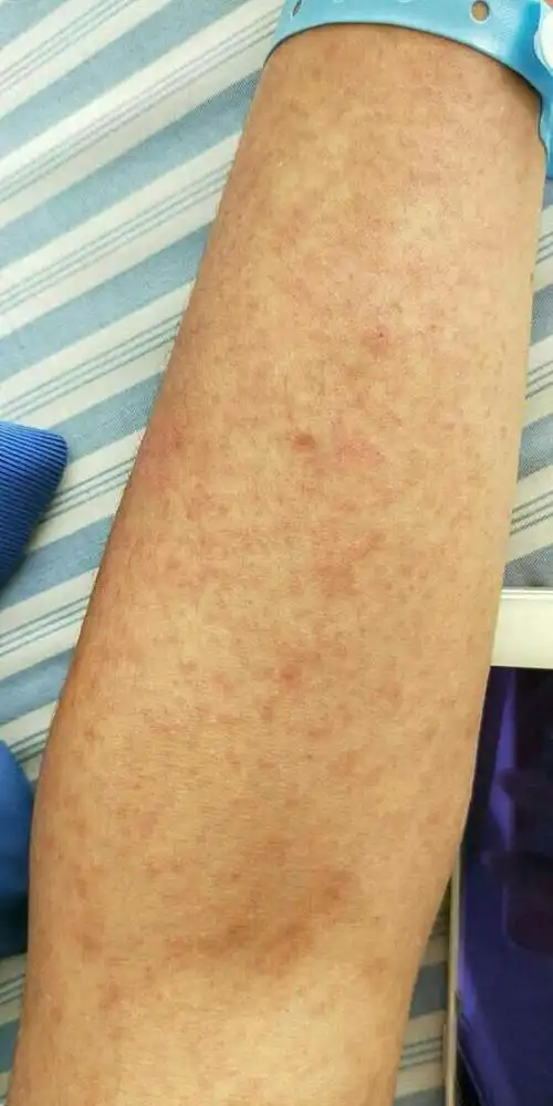 第一天发烧,第二天就全身出红疹,反复发烧,不痒,喉咙痛!病人15岁