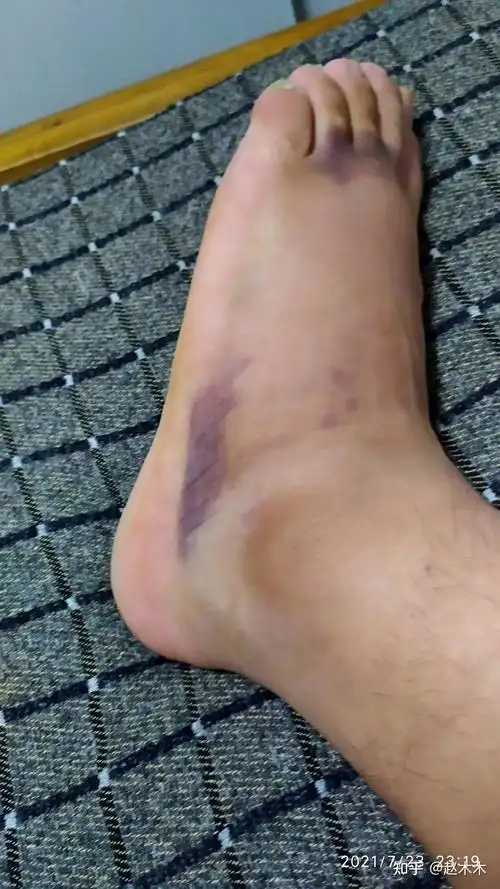 左足第五跖骨基底骨折