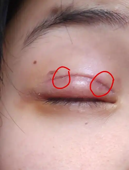刚刚觉得右眼皮越来越肿,看了一眼发现缝线处有好几个非常小的白色