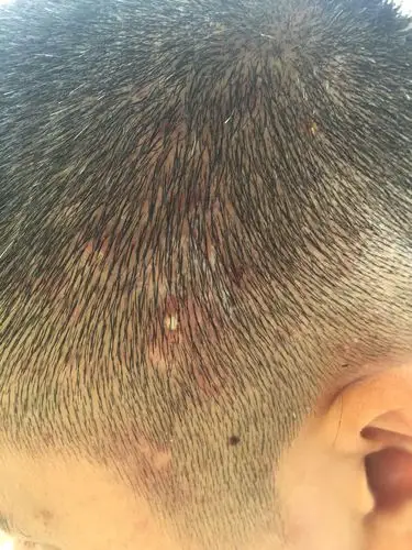 网上查了应该是染发过敏,头上长了很多包,灼痒,刺痛,已经长了一年多了