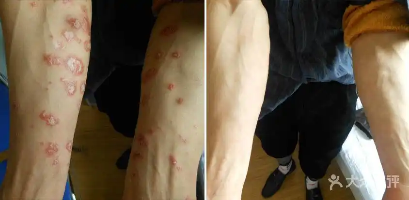 太原哪家皮肤科医院好