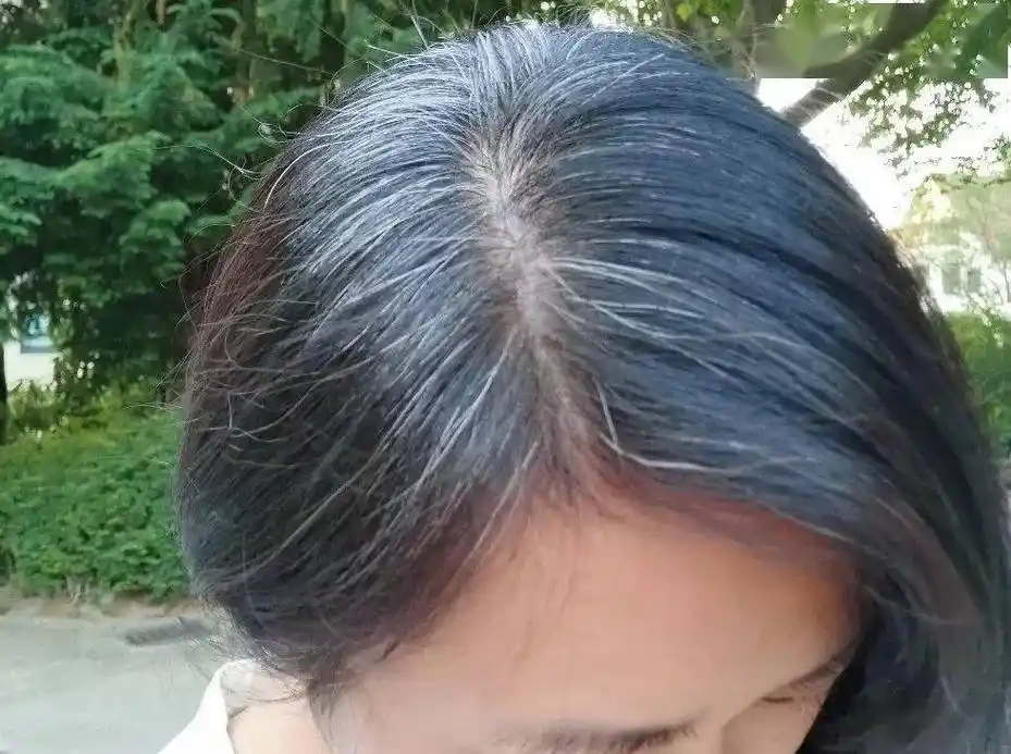 有白发不要着急染,洗发水换成它,白发悄悄黑回来,还能防掉发!_头皮