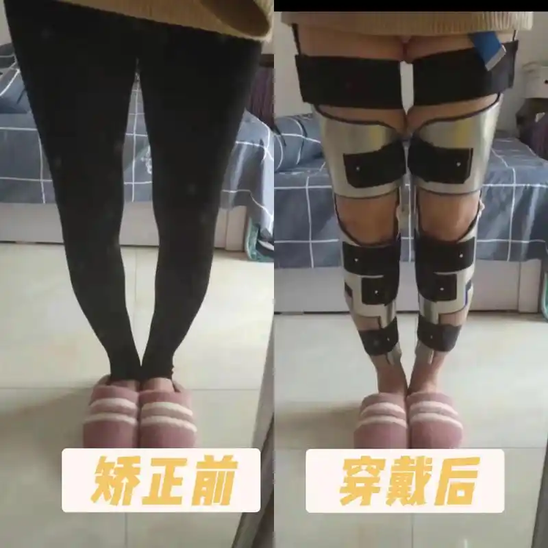 腿型矫正前后对比矫正效果立竿见影