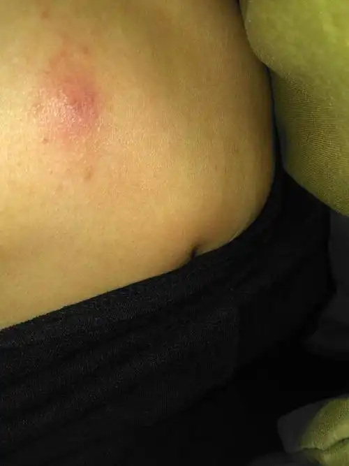 早晨起床突然有的,发现就这么大医生说是毛囊炎