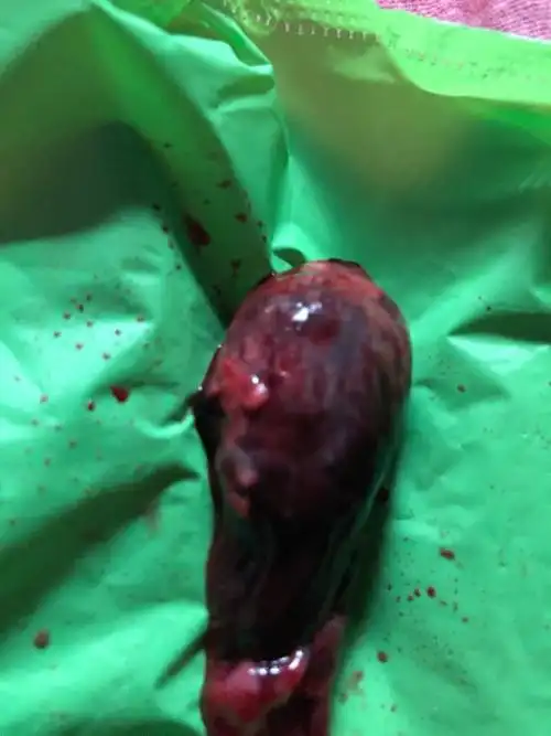 出血怀疑先兆流产腹痛一夜排出来的.