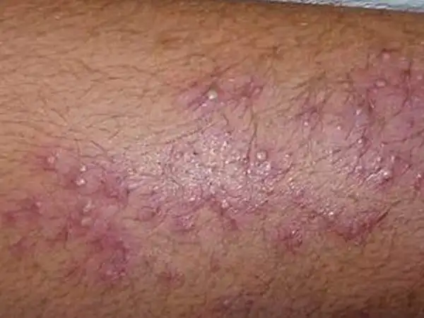 毛囊部位所发生的化脓性炎症,皮疹数目较多,孤立散在,自觉轻度疼痛