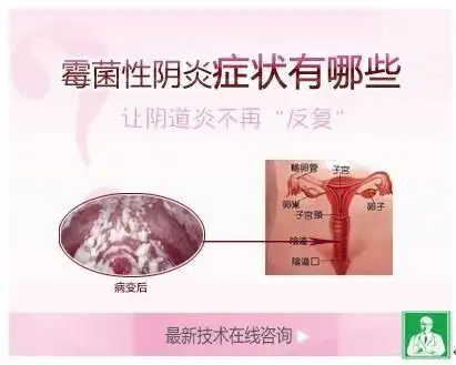 其中霉菌性阴道炎更是常见,不少怀疑自己得了该病的女性,更是希望通