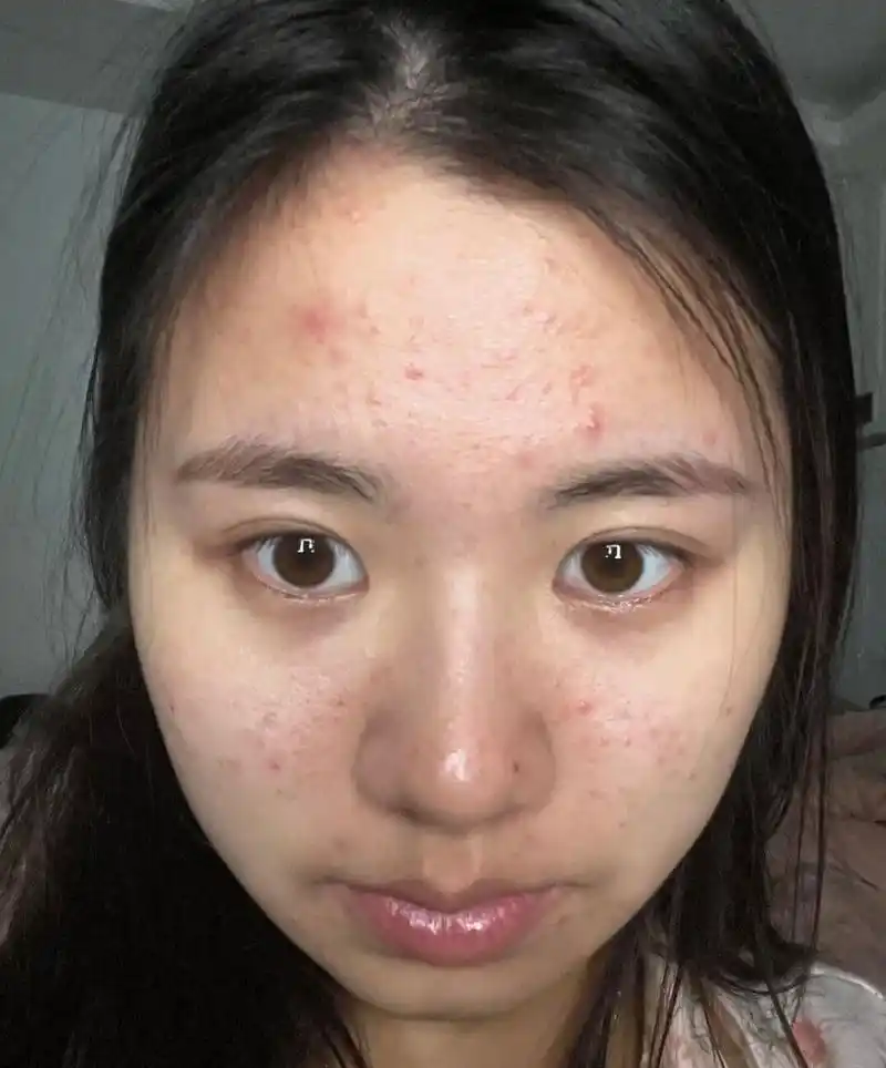 你会嫌弃你的女朋友皮肤不好长痘痘吗?