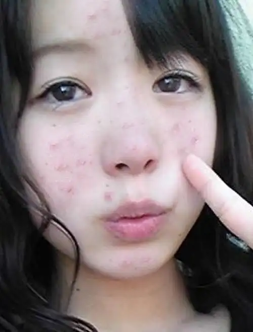 秋冬季痘痘皮肤咋办呢?说一下我的祛痘长征路吧