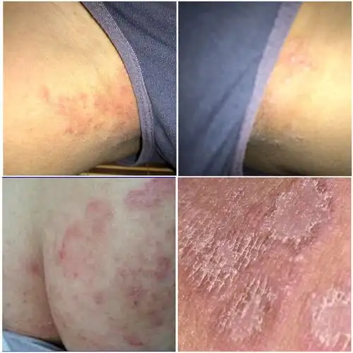 顽固头皮藓痒灵臀股大腿内侧成人皮肤痒止痒膏肛门阴囊湿痒吉夫宝
