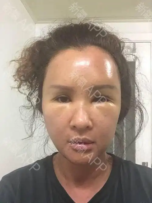 妹子太轻率了,随便选择一家美容店,不了解相关自体脂肪填充资料,至少