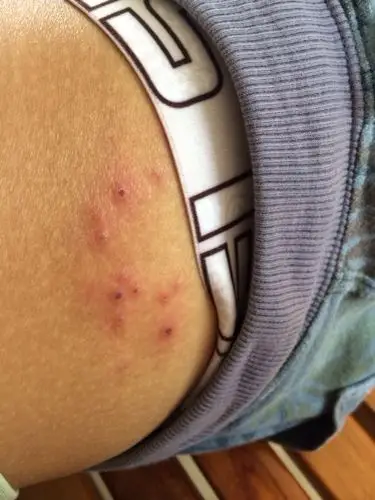 侧臀部长了一群胞,想知道什么原因引起的,到底是虫咬的还是其他炎症