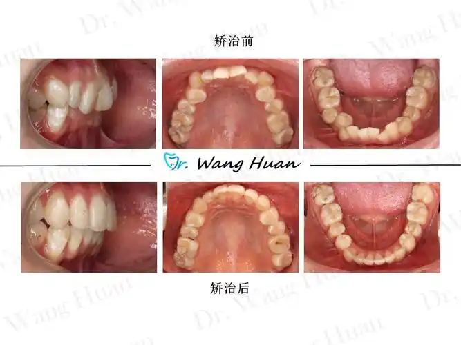 前牙的闭锁性深覆合,几乎看不到下颌的牙齿.