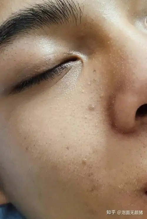 问:男生脸上毛孔粗大咋办?