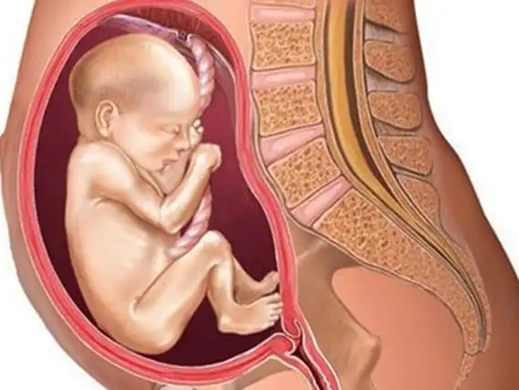 胎儿臀位是一种异常胎位