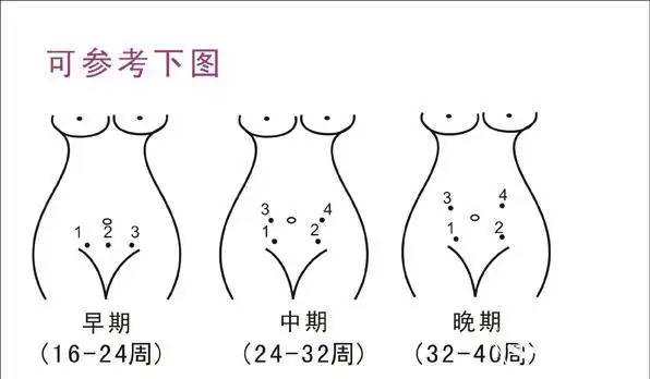 胎心位置示意图