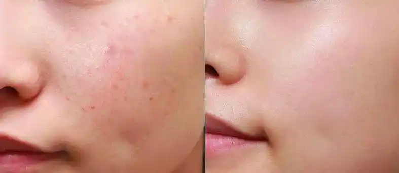 熬夜痘痘肌的救星小编脸很容易晒的红红的,红了以后皮肤就变黑,还有了