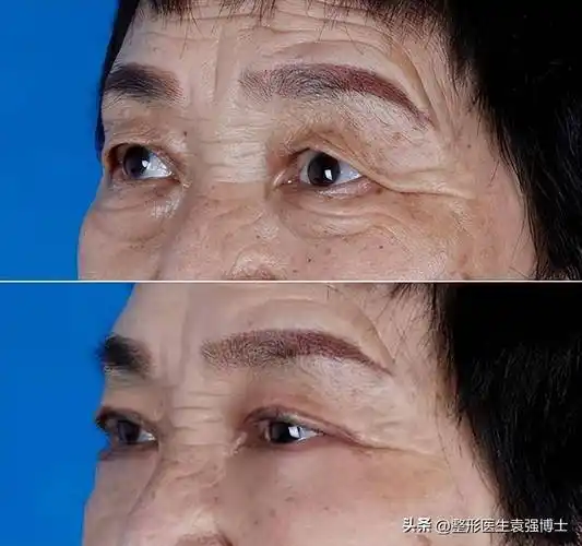 65岁女士,不顾他人眼光做了双眼皮 祛眼袋,这个手术必须做吗?