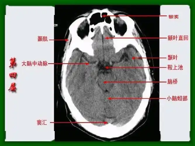 头颅ct 解剖图谱,人手一份