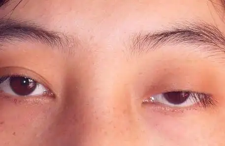 重症肌无力型上睑下垂