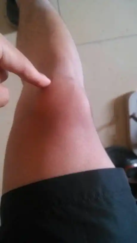 不小心膝盖跪地上了磕破了点皮还有点青膝盖弯曲的时候有点疼没有肿