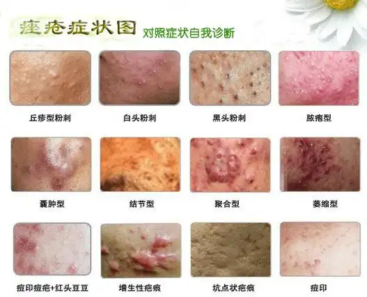 各种类型痤疮的症状和图片展示_太原肤康中医皮肤病医院