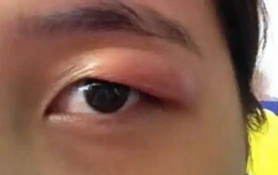 尿毒症降临时头上会出现3大现象希望你一个都收不到