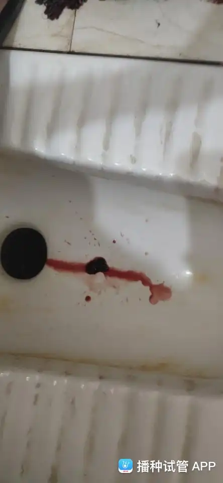 今天移值19天突然出血,会不会流产