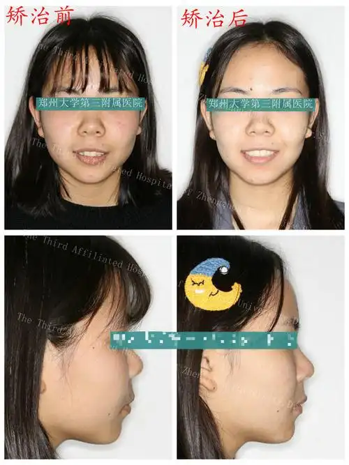 真真矫治前后对比图对于有小虎牙的小朋友大朋友们要注意啦!