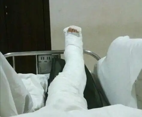 小伙吃霸王餐逃单时摔断腿事后竟向老板索要赔偿金法院将如何判