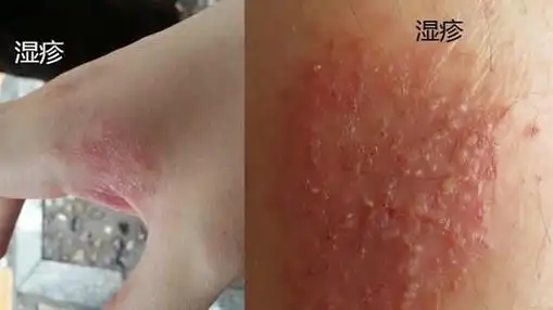 湿疹和癣的区别图片区分图对比