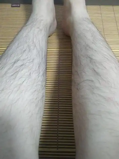 腿毛多主要是由于体内雄性激素分泌量比较高造成,雄性激素促使