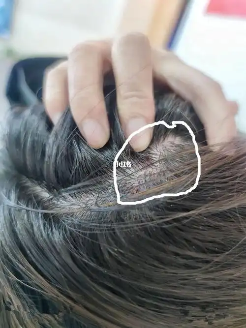 脂溢性皮炎头皮好了,没头皮屑和痘痘的快乐 03有被头皮屑困扰的上班