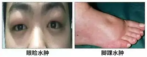 那一夜,"默默无闻"的肾病偷走我第一次眼泪