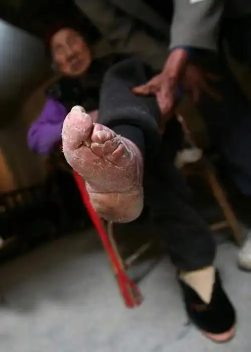 缠足是中国古代的一种陋习,即把女子的双脚用布帛缠裹
