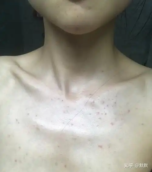 对抗马拉色菌毛囊炎 - 知乎