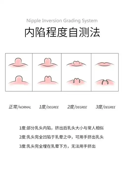 自测一下您是否存在乳头内陷