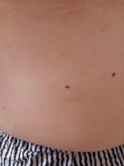 这个红点是怎么回事,全身都有这个是最严重的