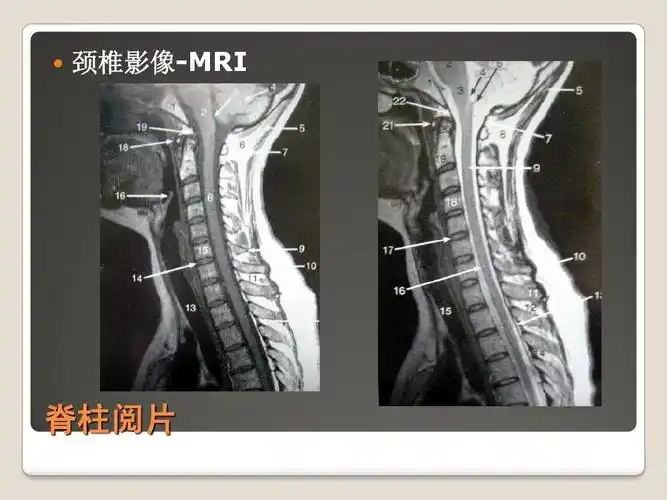(共44页,当前第29页) 你可能喜欢 mri读片 x线读片 颈椎mri x线解剖
