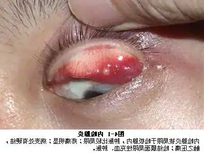 睑jian板腺囊肿麦粒肿的同胞兄弟
