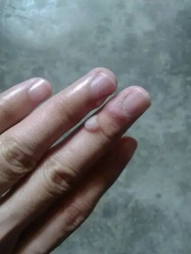 长了两年了原先没注意也不清楚这是什么但是今年开始手上长了好多已经