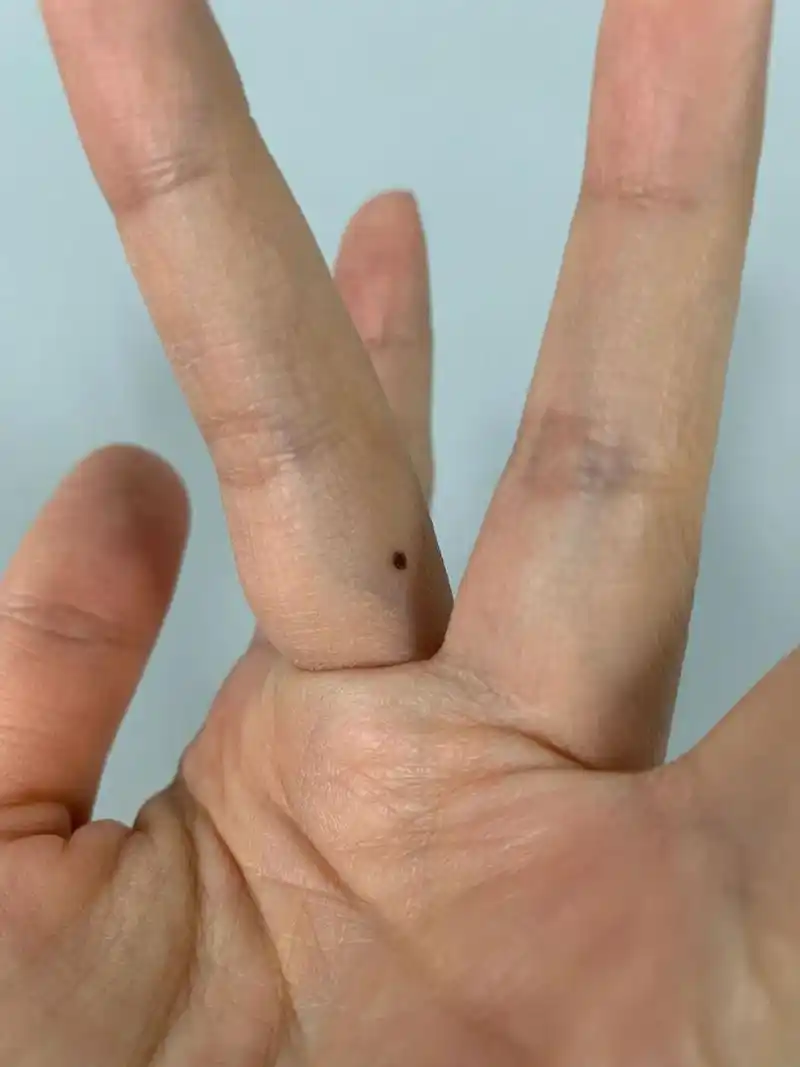 手上突然长了个痦子,怎么回事?