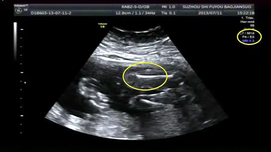 辨别胎儿性别有方法,b超单上一清二楚,再也不用求医生了!