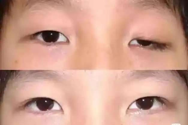 重症肌无力之眼睑下垂不用怕中医能治