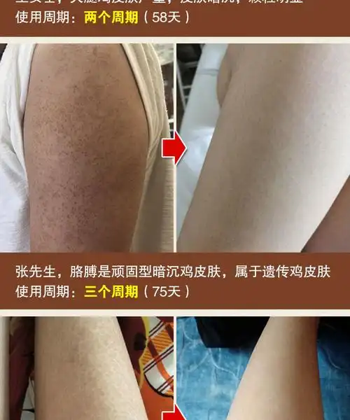 磨砂膏去鸡皮胳膊上的小疙瘩去腿上毛孔手臂胳膊毛囊堵塞疏通小红点去