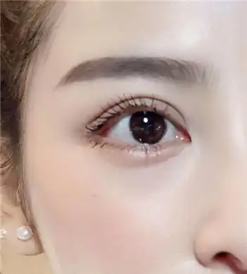 讲述双眼皮修复的亲身经历,想看的点进来看吧