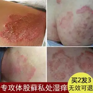 00142人付款天猫肛周脓肿肛瘘止痒膏肛门瘙痒屁股肛裂阴囊潮湿屁眼痒