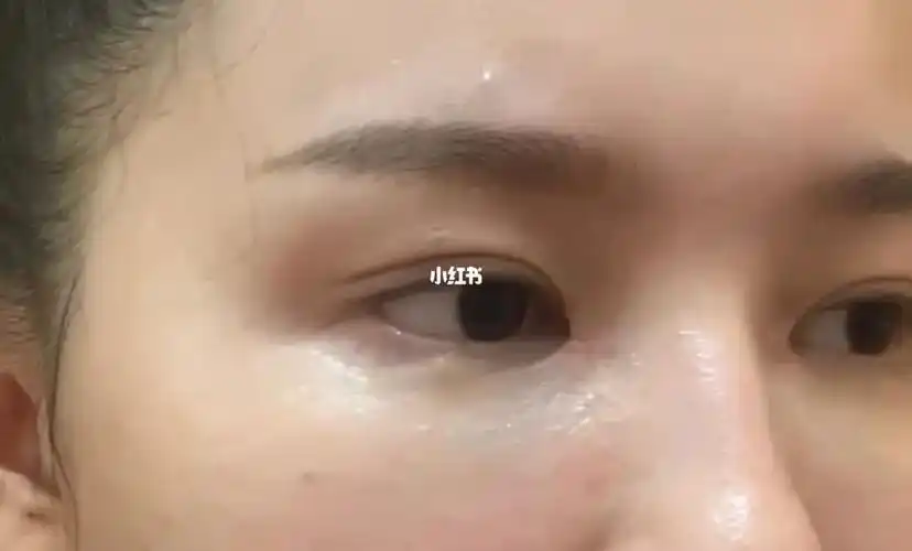 包眼角48天 这眼角?包的成功?图三是术前.