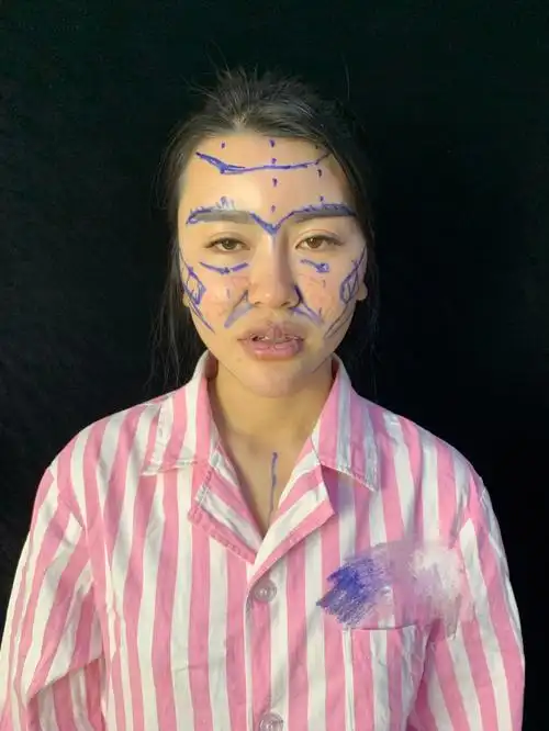 面部脂肪填充全过程