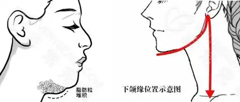 做完面部吸脂以后双下巴更明显了,这是为什么?